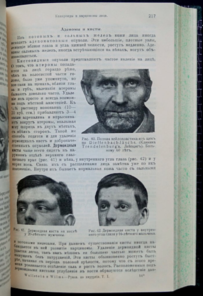 Вулльштейн и Вильмс. Руководство по хирургии. Трёхтомное издание (1913)